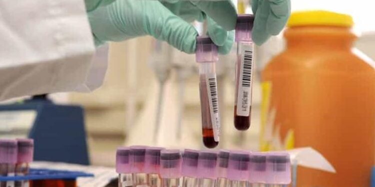 Covid, Regione aderisce a progetto europeo per raccolta plasma. Spirlì: «Donare per salvare vite»